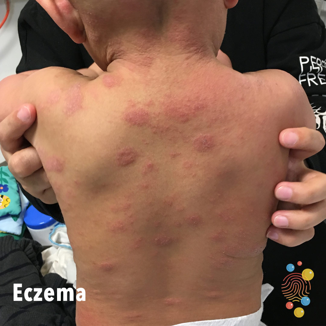 KC2b-eczema.jpg