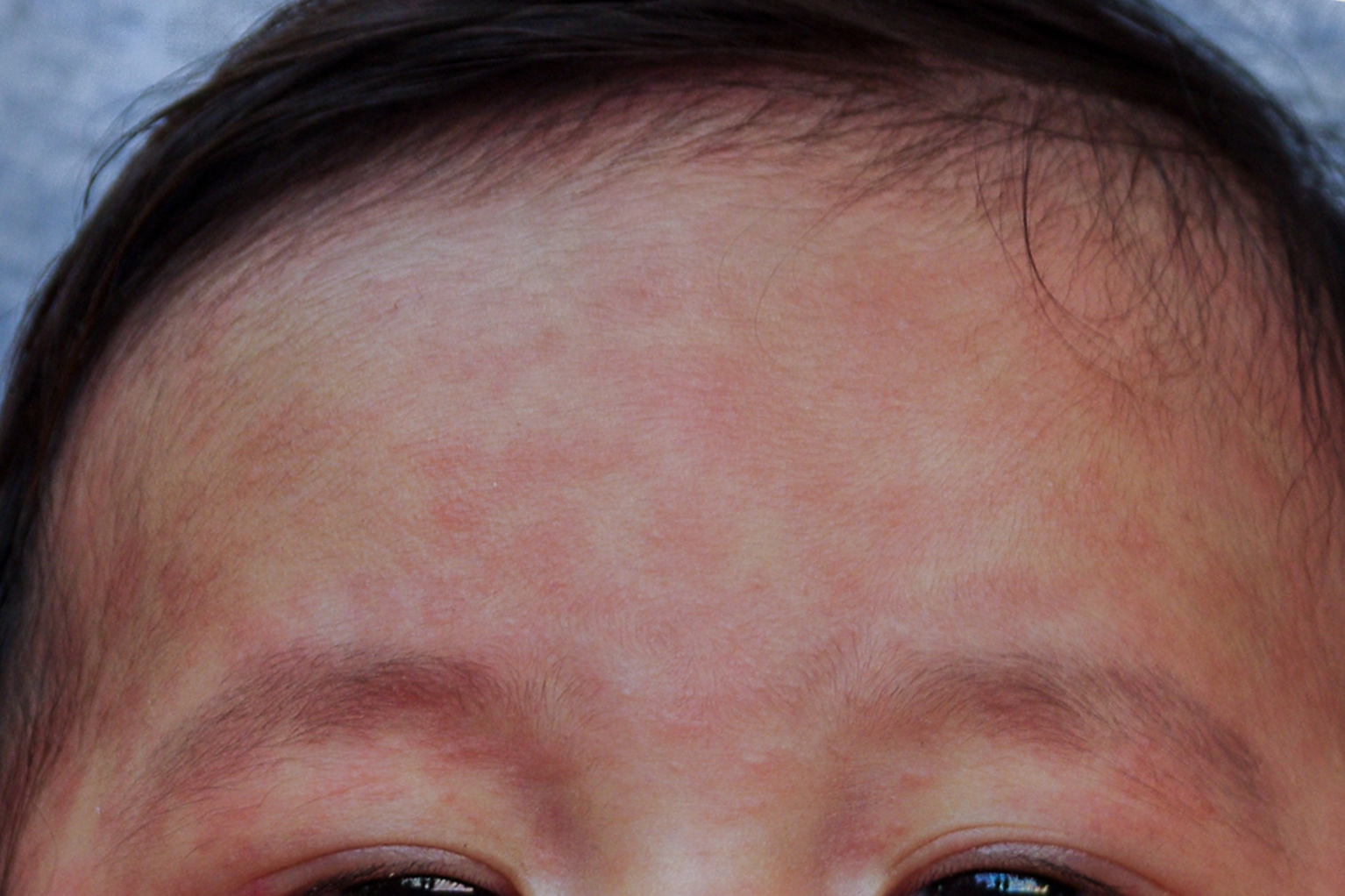 Measles face NHS.png